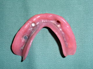 マグネットを埋め込んだ義歯の写真