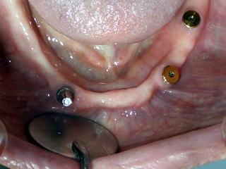 インプラントにマグネットのくっつく土台を装着した写真(ミラーによる反転画像)