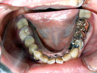 メタルプレート義歯装着時の写真(ミラーによる反転画像)