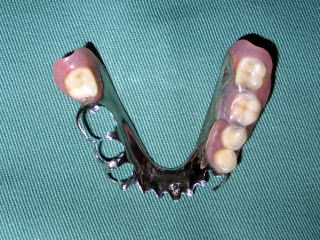 メタルプレート義歯の写真